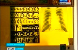 Фыййагдоны пульмонологон рынчындонæн Цæгат Кавказы æмбал нæй