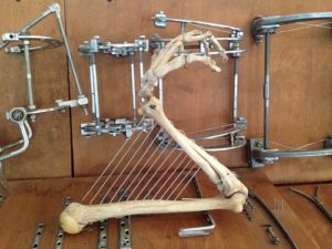 Доктор Кудзаев изготовил из скелета человеческой руки двенадцатиструнную арфу