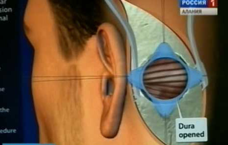 Нейрохирурги Северокавказского медицинского многопрофильного центра проводят уникальные операции