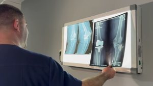 Более 300 пациентам КБСП провели эндопротезирование тазобедренных и коленных суставов