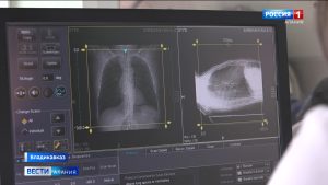 В Северной Осетии с начала года провели более 65 тысяч исследований с использованием ИИ